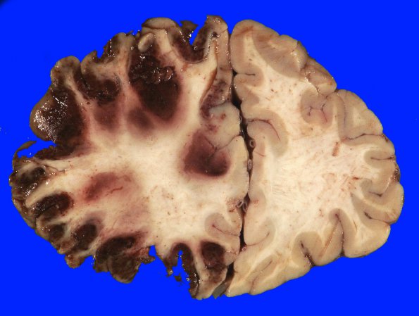 1A1 Infarct, recent, hemorrhagic (Case 1) 4