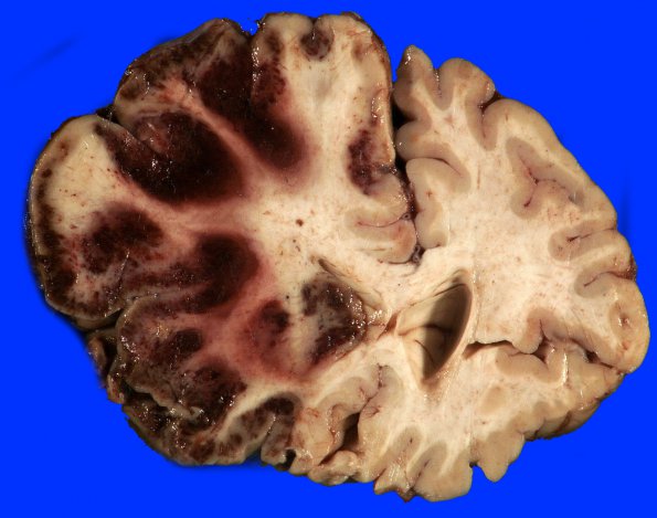 1A2 Infarct, recent, hemorrhagic (Case 1) 5