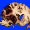 1A3 Infarct, recent, hemorrhagic (Case 1) 6