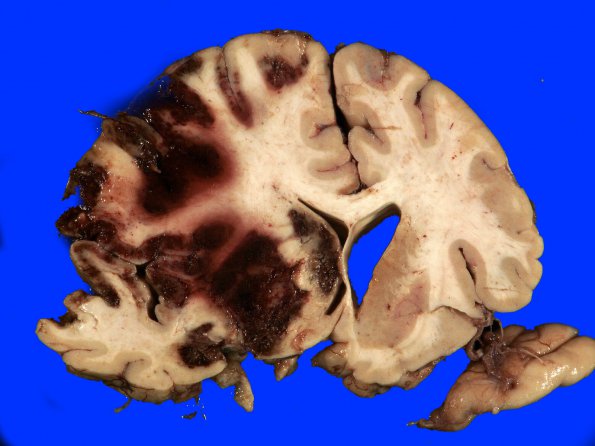 1A3 Infarct, recent, hemorrhagic (Case 1) 6