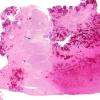 1B1 Infarct, hemorrhagic (Case 1) H&E N12  8