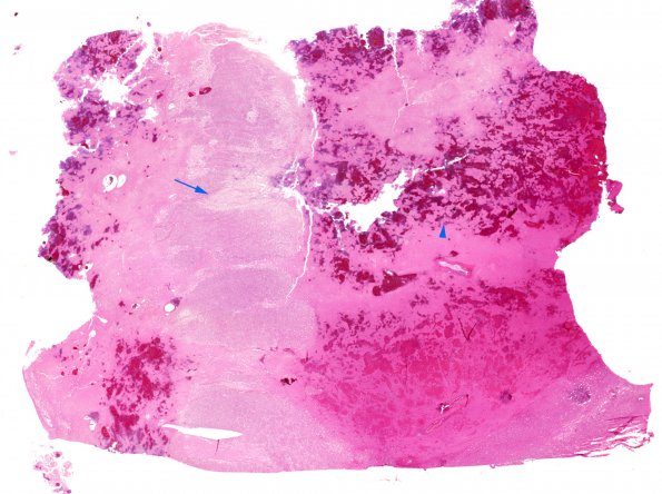 1B1 Infarct, hemorrhagic (Case 1) H&E N12  8