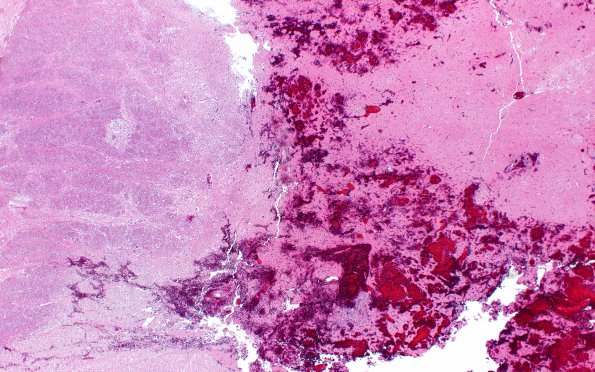 1B2 Infarct, hemorrhagic (Case 1) H&E N12  2X