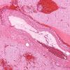 1B3 Infarct, recent, hemorrhagic (Case 1) H&E 10