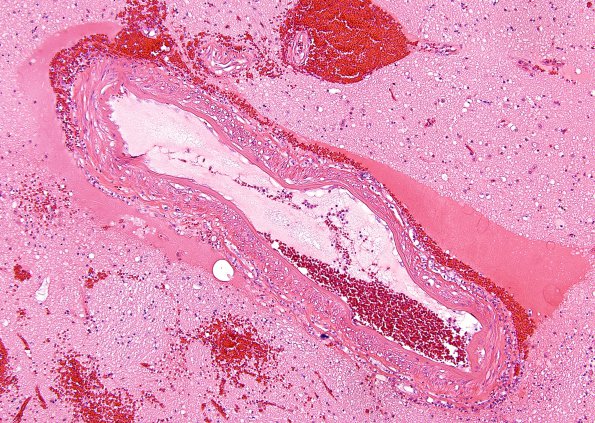 1B3 Infarct, recent, hemorrhagic (Case 1) H&E 10