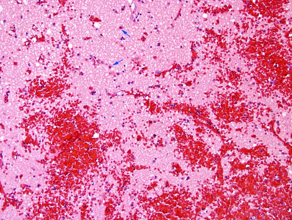 1B4 Infarct, recent, hemorrhagic (Case 1) H&E 7