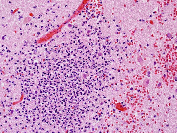 1B5 Infarct, recent, hemorrhagic (Case 1) H&E 6