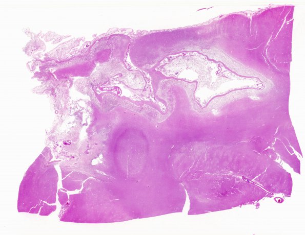 1C1 Infarct, recent, hemorrhagic (Case 1) N10 H&E WM