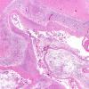 1C2 Infarct, hemorrhagic (Case 1) H&E N10 2X