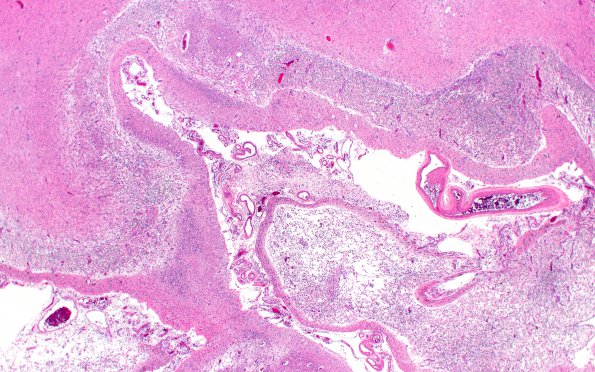 1C2 Infarct, hemorrhagic (Case 1) H&E N10 2X