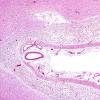 1C3 Infarct, recent, hemorrhagic (Case 1) H&E 1Adobe