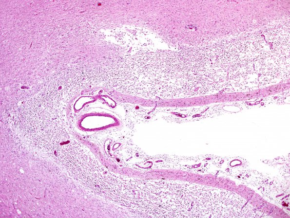 1C3 Infarct, recent, hemorrhagic (Case 1) H&E 1Adobe