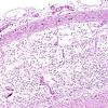 1C4 Infarct, recent, hemorrhagic (Case 1) H&E 2