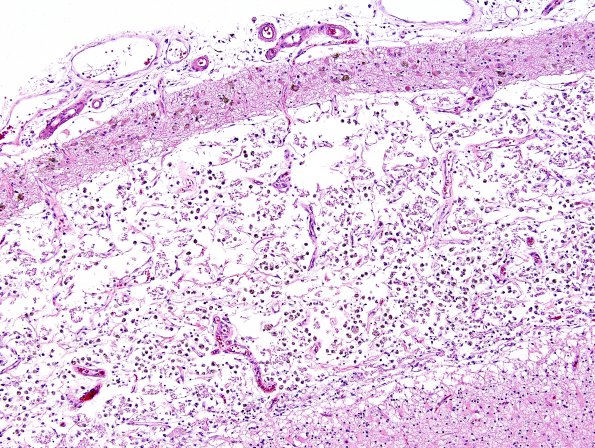 1C4 Infarct, recent, hemorrhagic (Case 1) H&E 2