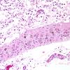 1C5 Infarct, recent, hemorrhagic (Case 1) H&E 3 (2)