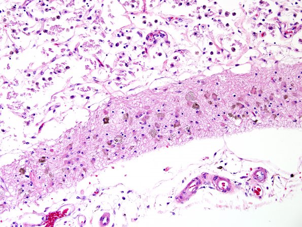 1C5 Infarct, recent, hemorrhagic (Case 1) H&E 3 (2)