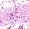 1C6 Infarct, recent, hemorrhagic (Case 1) H&E 7 (3) copy