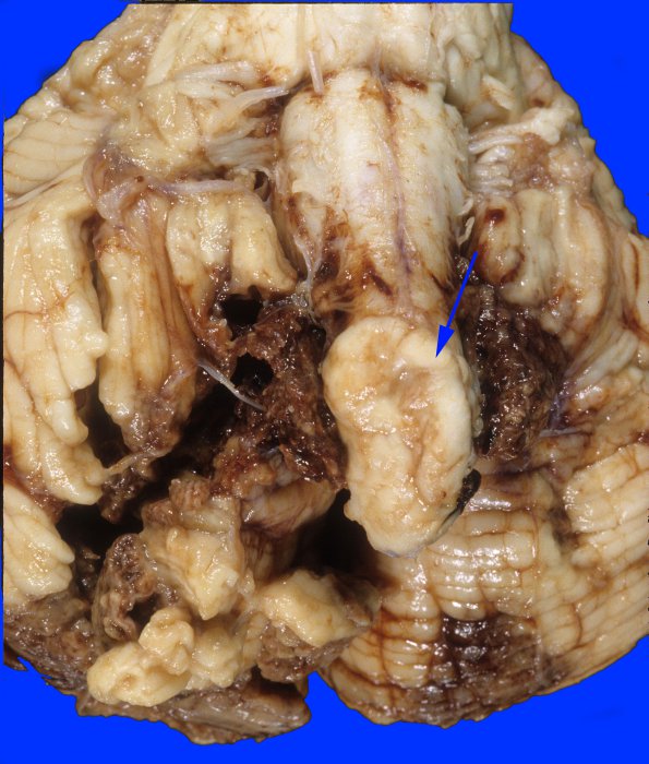 2A1 Hemorrhagic Infarct (Case 2) 4 copy