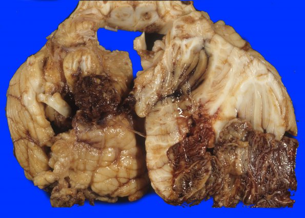 2A2 Hemorrhagic Infarct (Case 2) 6