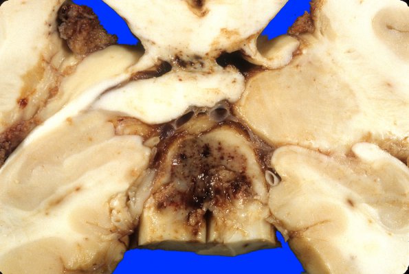 2A3 Hemorrhagic Infarct (Case 2) 23