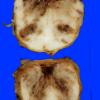 2A4 Hemorrhagic Infarct (Case 2) 5