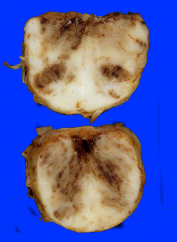 2A4 Hemorrhagic Infarct (Case 2) 5