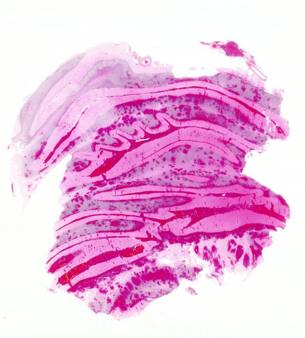 2B1 Hemorrhagic Infarct (Case 2) N26 H&E WM