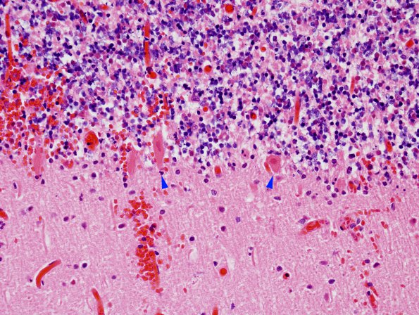 2B3 Hemorrhagic Infarct (Case 2) N26 H&E 1 copy