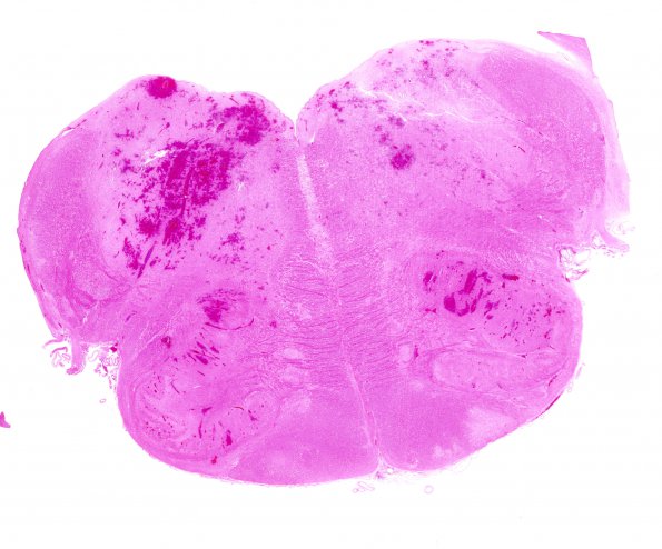 2B5 Hemorrhagic Infarct (Case 2) N8 H&E WM