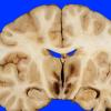 2C1 Hemorrhagic Infarct (Case 2) 10