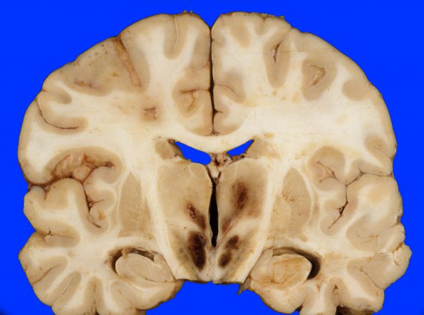 2C1 Hemorrhagic Infarct (Case 2) 10