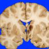 2C2 Hemorrhagic Infarct (Case 2) 14