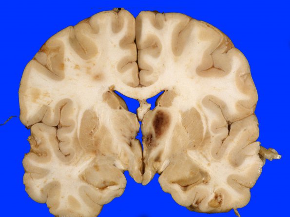 2C2 Hemorrhagic Infarct (Case 2) 14