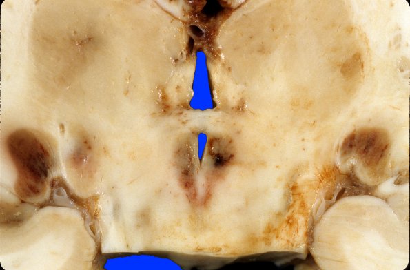 2C3 Hemorrhagic Infarct (Case 2) 19