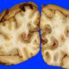 2C4 Hemorrhagic Infarct (Case 2) 25