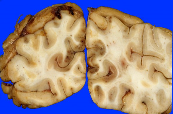 2C4 Hemorrhagic Infarct (Case 2) 25