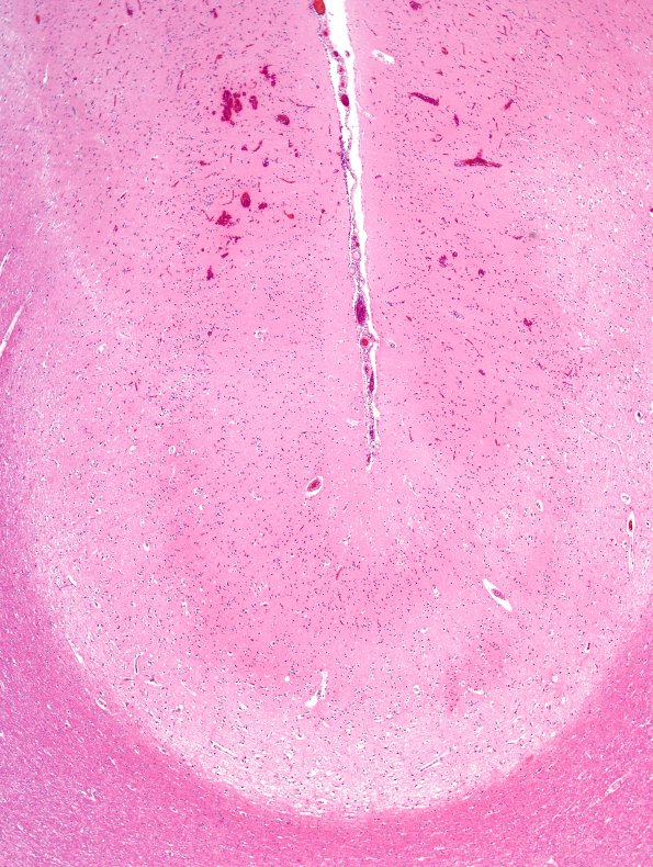 2D1 Hemorrhagic Infarct (Case 2) N5 H&E 2