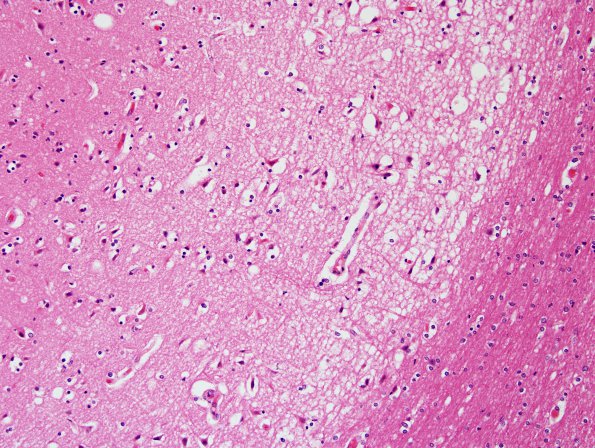 2D2 Hemorrhagic Infarct (Case 2) N5 H&E 7