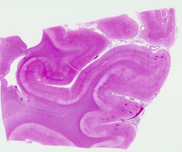 2D3 Hemorrhagic Infarct (Case 2) N5 H&E WM