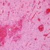 2D4 Hemorrhagic Infarct (Case 2) N8 H&E 2