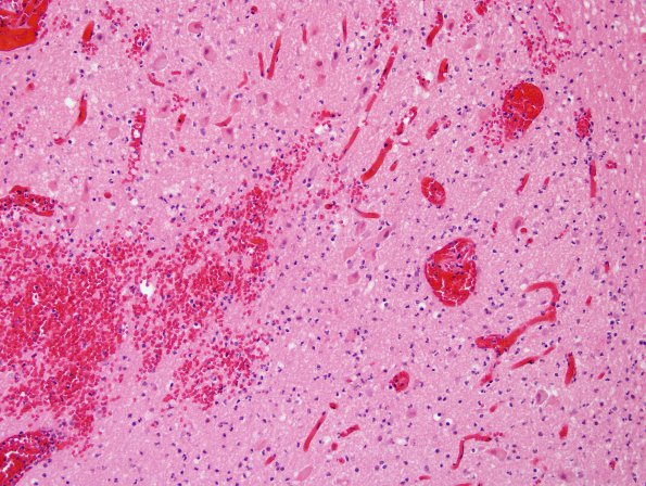 2D4 Hemorrhagic Infarct (Case 2) N8 H&E 2