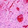 2D5 Hemorrhagic Infarct (Case 2) N8 H&E 3