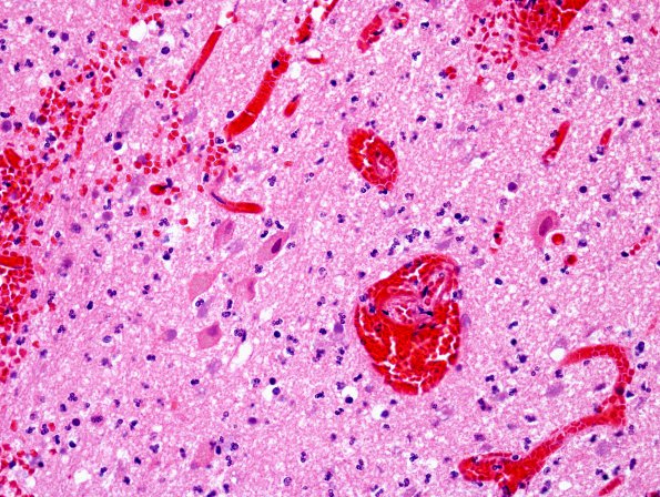 2D5 Hemorrhagic Infarct (Case 2) N8 H&E 3