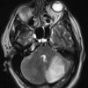 3A1 Infarct, hemorrhagic, recent, basilar, (Case 3) T2 W 3 - Copy