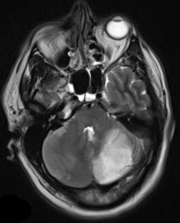 3A1 Infarct, hemorrhagic, recent, basilar, (Case 3) T2 W 3 - Copy