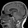 3A2 Infarct, hemorrhagic, recent, basilar, (Case 3) T1 1 - Copy