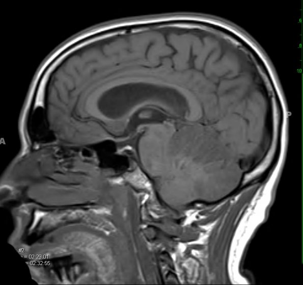 3A2 Infarct, hemorrhagic, recent, basilar, (Case 3) T1 1 - Copy