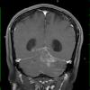 3A3 Infarct, hemorrhagic, recent, basilar, (Case 3) T1 W 3A - Copy