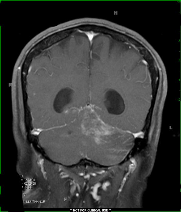 3A3 Infarct, hemorrhagic, recent, basilar, (Case 3) T1 W 3A - Copy