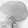 3B1 Infarct, hemorrhagic, recent, basilar, (Case 3) MRA 1 - Copy